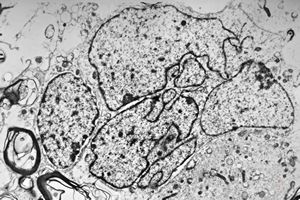F,15y. | fibrillary astrocytoma F,15y. | fibrillary astrocytoma